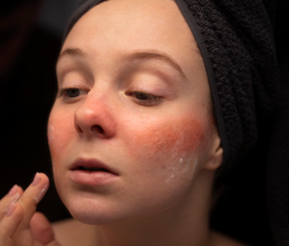 Rosacea
